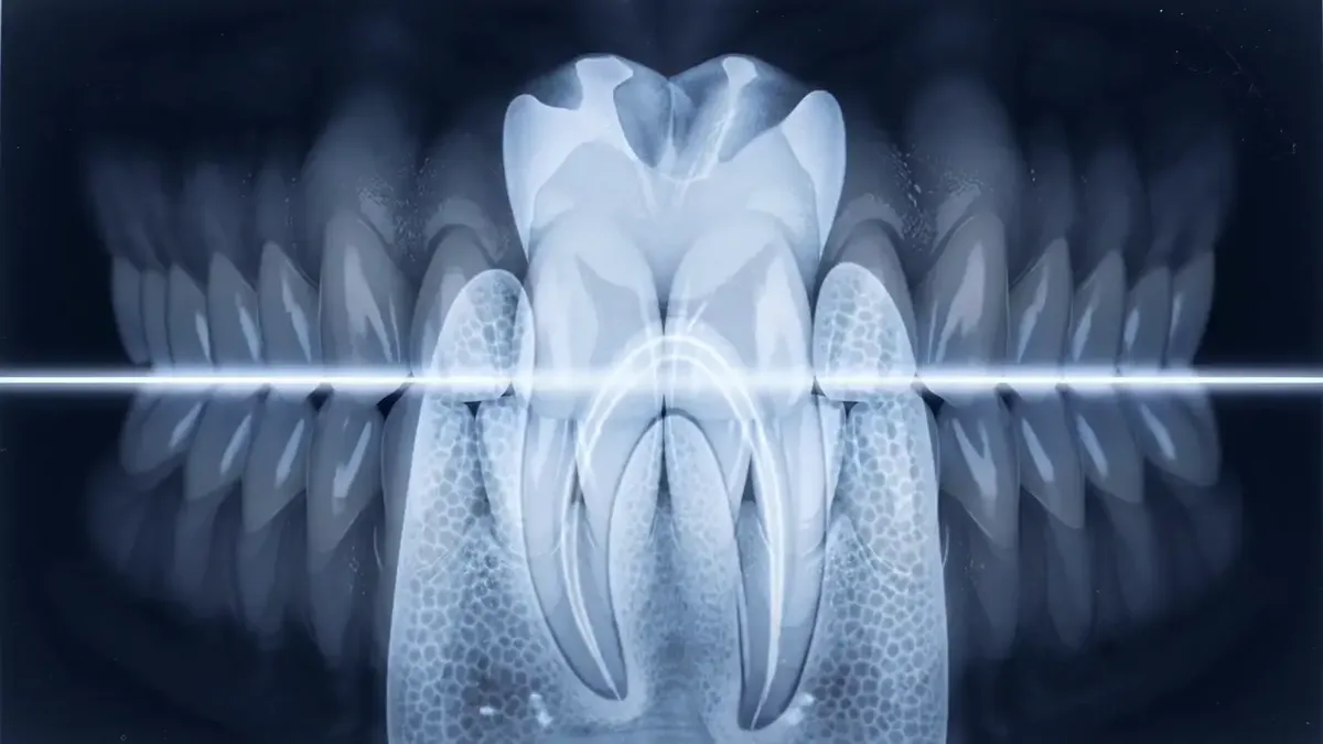 The crown of a tooth on a radiograph, the enamel layer bright against the softer structure beneath