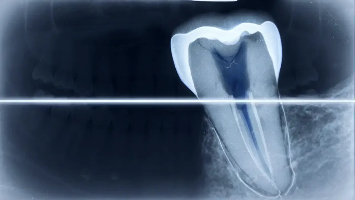 A single molar in cross section on a dental radiograph, its root canal visible as a bright line