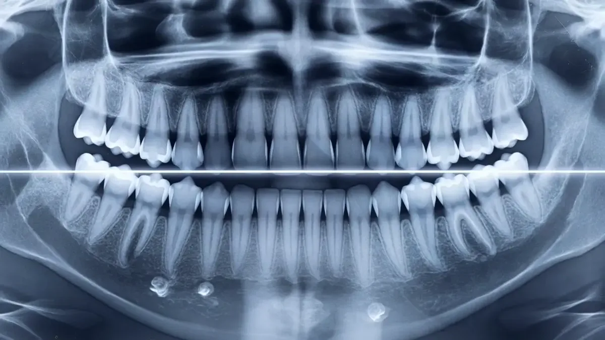 A wide dental radiograph showing the full lower jaw and the surrounding bone