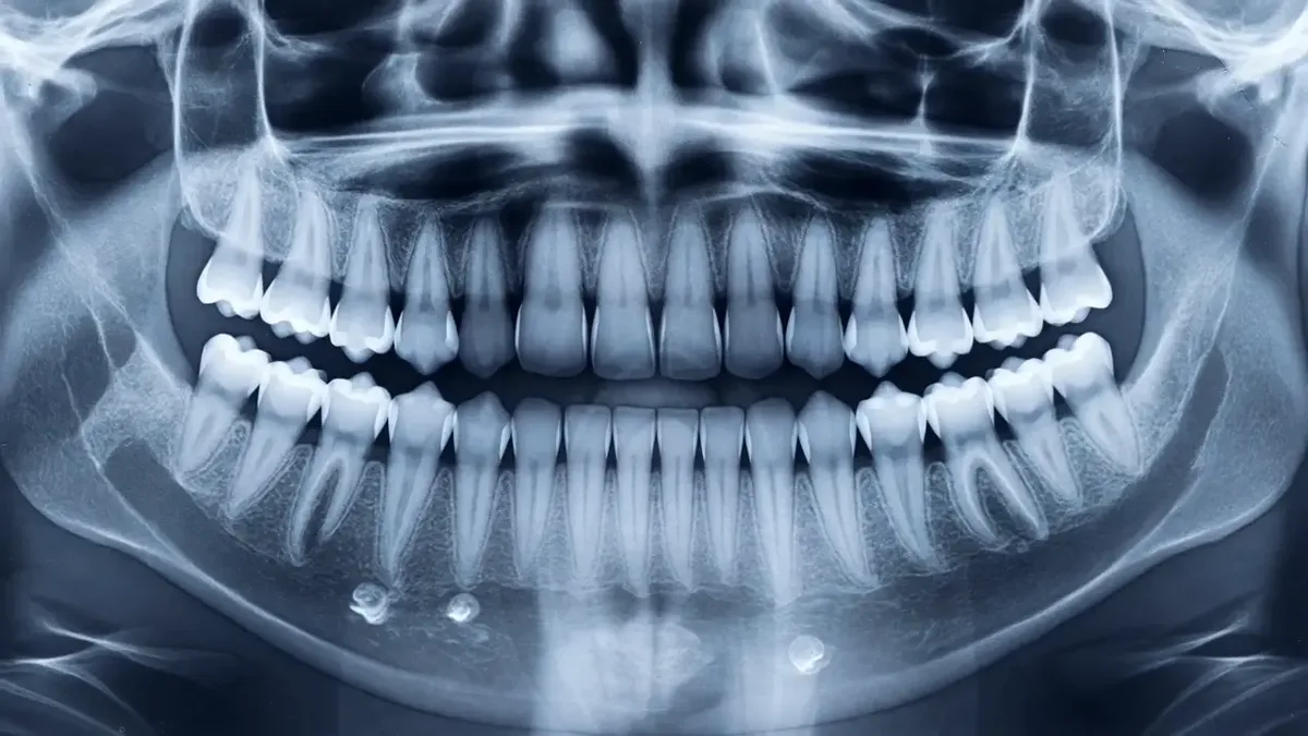 A panoramic dental radiograph showing the full arch of teeth including the back molars