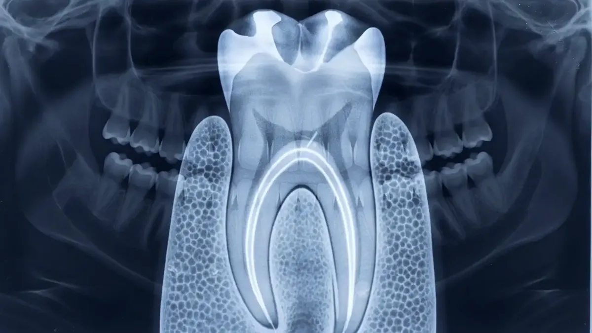 Tooth roots on a radiograph, the socket outline visible around them