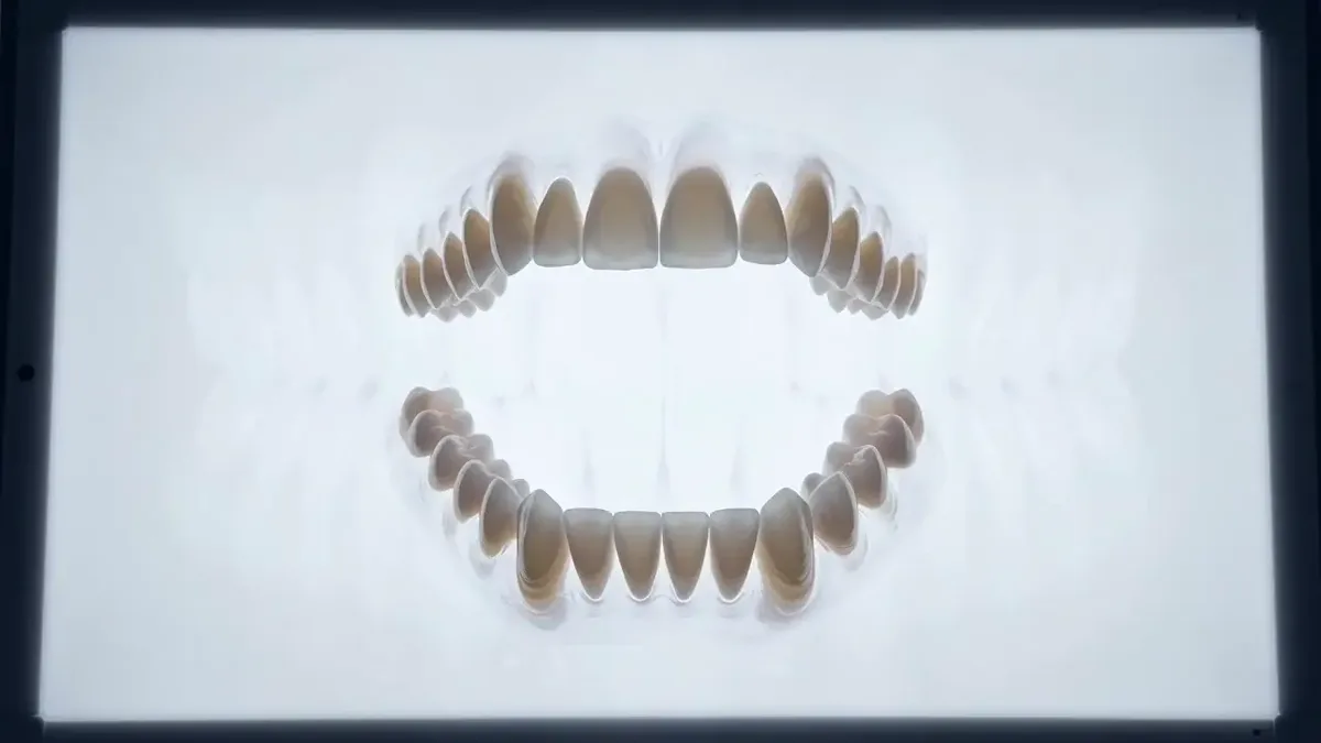 A restored tooth on a lit radiograph viewbox, the restoration reading brighter than the tooth around it